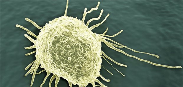 Künstliche Intelligenz klassifiziert Darmkrebs Krebszelle: Auch in der Diagnostik von Tumoren gewinnt künstliche Intelligenz an Bedeutung.