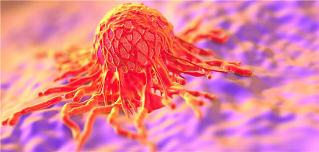 Krebszelle: Verschiedene Faktoren erhöhen oder verringern die Gefahr für ein kolorektales Karzinom.