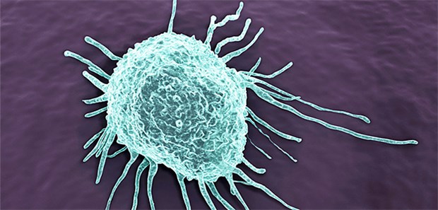 Krebszelle auf Wanderschaft. Metastasiert z. B. Brustkrebs ins Gehirn, können auch Paresen der Zunge auftreten.