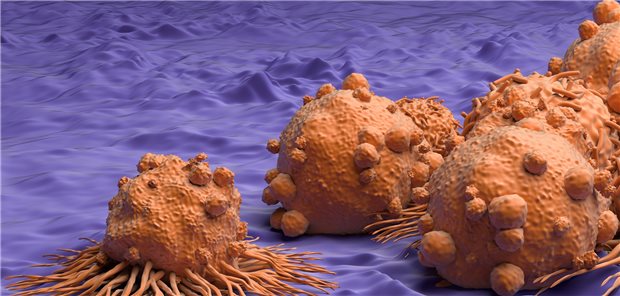 Krebszellen: Tumorimpfstoffe könnten besonders nützlich sein, um residuale Tumorzellen zu beseitigen oder um Erkrankungsrezidive zu vermindern.