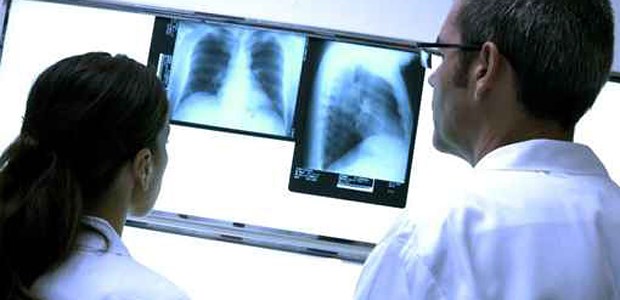 Tuberkulose liefert den ASV-Prototypen Kritischer Blick auf den Thorax: Tuberkulosen werden zum Modell für die ASV.