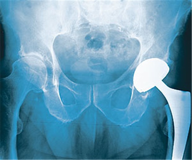Listerien brüten gern im Kunstknie Künstliches Hüftgelenk: In Nischen um das Implantat können sich Listerien ansiedeln.