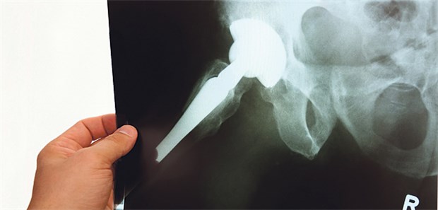 Künstliches Hüftgelenk im Röntgenbild: Bei ein bis drei Prozent der Endoprothesen treten Infektionen auf.