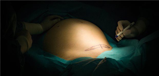 Kurz vor der Sectio. Welche Vor-und Nachteile kann ein wiederholter Kaiserschnitt haben?