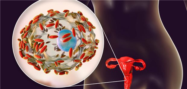 Mit intravaginaler Ascorbinsäure gegen bakterielle Vaginose Dreidimensionale Illustration einer bakteriellen Vaginose, bei der das Vaginalsekret Epithelzellen, sogenannte Clue-Zellen enthält, die mit Bakterien der Gattung Gardnerella vaginalis besiedelt sind.