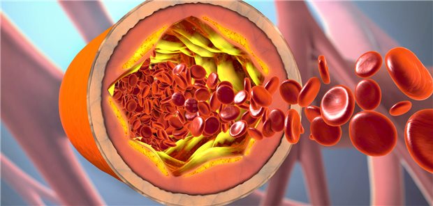 Plaques in Gefäßen