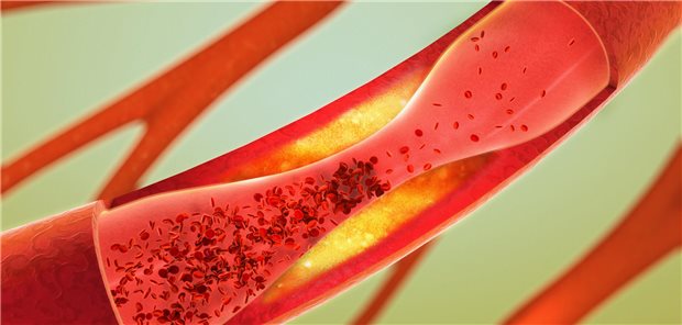 Grafik eines Gefäßes mit Atherosklerose