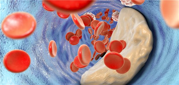 LDL spielt für koronare Herzerkrankungen eine wichtigere Rolle als für den ischämischen Insult.