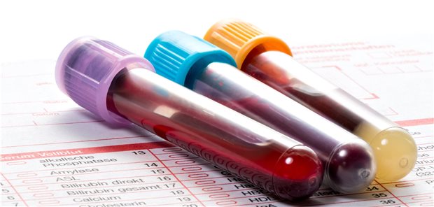 Laborcheck: Typische Befunde bei alkoholischer Leberkrankheit mit begleitender Autoimmunhepatitis sind ALT- und/oder AST-Werte  300, AST-ALT-Quotient  1, hohe gamma-GT und erhöhtes IgG. (Symbolbild mit unbeschrifteten Röhrchen)