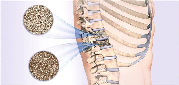 Längsschnitt durch zwei Rückenwirbel: der obere hat eine normale Knochendichte, der untere ist aufgrund geringerer Knochendichte eingefallen. Grund für die Osteoporose kann auch eine topische Glukokortikoid-Therapie sein.