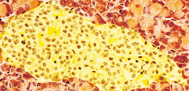 Typ-1-Diabetes, ohne Insulin zu spritzen? Das könnte wahr werden Langerhans’sche Inselzellen (gelb) im Schnittbild der Bauchspeicheldrüse.