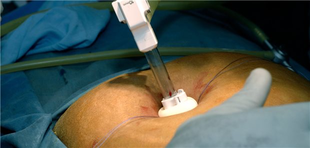 Laparoskopische Cholezystektomie: Eine Studie zufolge kann es sich lohnen, vor dem Eingriff eine perkutane Drainage vorzunehmen.