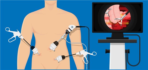 Laparoskopische „Drei-Port-Appendektomie“: Bezüglich der Intensität postoperativer Schmerzen gibt es dabei im Vergleich zum offenen Verfahren klare Vorteile.