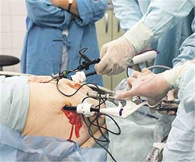 "Magen-Op kein Allheilmittel gegen Diabetes" Laparoskopischer Eingriff: Viele Ärzte sehen Magenoperationen gegen Typ-2-Diabetes skeptisch.