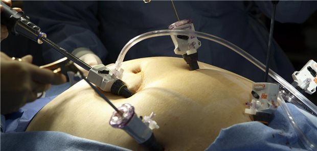 Bild eines Bauches einer Person an der gerade eine laparoskopische Magenbypass-Operation durchgeführt wird. 
