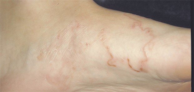 Larva migrans: Die Übertragung erfolgt über den Kot von Hunden und Katzen.