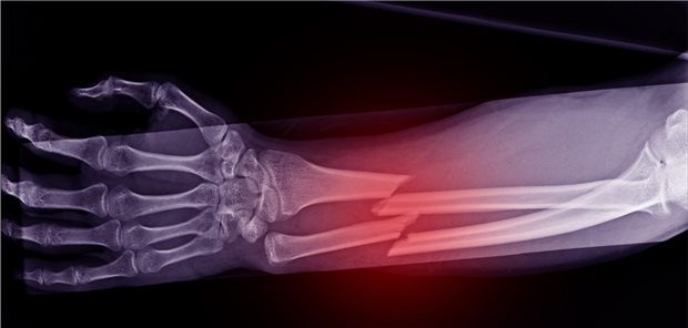 Laut Auswertung bevölkerungsbasierter Daten aus der Nord-Trøndelag Gesundheitsstudie hatten, verglichen mit der zahlenmäßig weit größeren Nicht-Rheumatoider Arthritis-Kohorte, Menschen mit Rheumatoider Arthritis ein um etwa 40 Prozent höheres Frakturrisiko. 