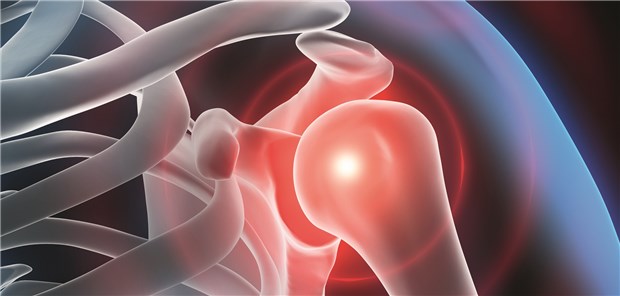 Laut Daten des Bundesverbandes Medizintechnologie implantieren deutsche Orthopäden jährlich etwa 25000 künstliche Schultergelenke.