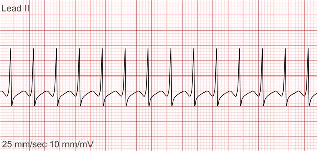 Laut Erstautor Lifeng Xiao (University Medical College Shantou) und Mitforschende, hat die Kombinationstherapie zur Beendigung von paroxysmalen supraventrikulären Tachykardien eine relative hohe Erfolgsrate und ein gutes Sicherheitsprofil. Die aktuelle Studie konnte jedoch keine Überlegenheit der Kombinationstherapie gegenüber alleiniger Behandlung mit Adenosin zeigen. 