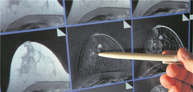 Laut IGeL-Monitor „tendenziell negativ“: Die MRT zur Brustkrebsfrüherkennung.