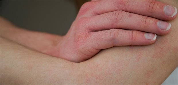 Eine Hand mit geröteten Stellen liegt auf einem Arm, der ebenfalls gerötete Stellen aufweist.