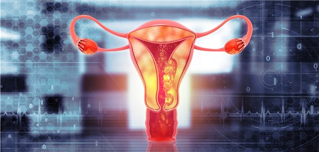 Laut dem Robert Koch-Institut erkrankten im Jahr 2018 10.860 Frauen an einem Endometriumkarzinom.