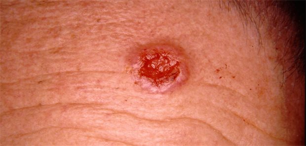 Basalzellkarzinom, exulzeriertes m 62 Stirn