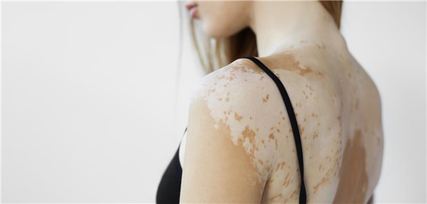 Rückenansicht einer Frau mit Vitiligo - einer Hautkrankheit, die einen Melaninverlust verursacht.