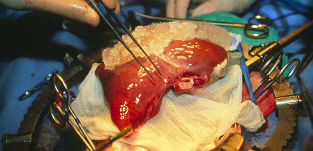 Ein Qualitätsproblem und ein Dementi Leber kurz vor ihrer Implantation: Erneut schreckt ein Bericht über angebliche Verfehlungen die Transplantationsmedizin auf.