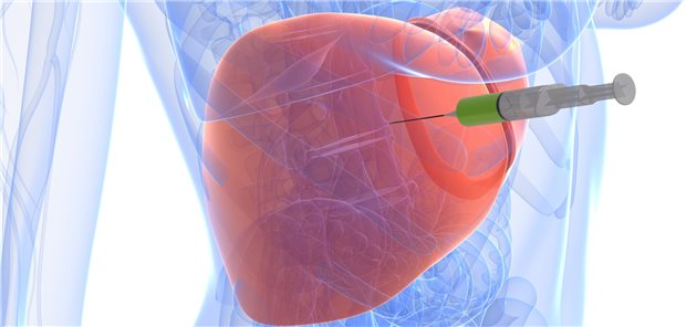 Leberbiopsie – wer braucht eine, wer nicht? Hinweise darauf könnte der Anstieg der Lebersteifigkeit in der vibrationskontrollierten transienten Elastografie auf Werte über 14,9 kPA geben.