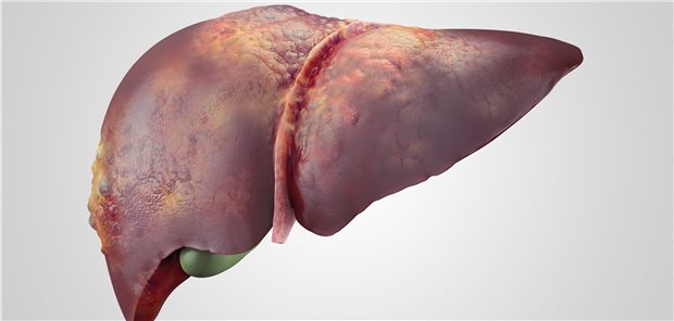 Leberkrebs – Forscher haben dazu jetzt epidemiologische Daten unter die Lupe genommen.