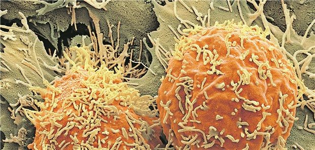 Leberkrebszellen im Elektronenmikroskop.