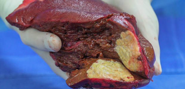 Spezialärzte fürchten Hürdenlauf Lebermetastase: Für die ASV bei gynäkologischen Tumoren könnten die Regelungen zu gastrointestinalen Tumorerkrankungen als Vorbild dienen.