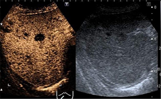 Allround-Talent Sonografie Lebermetastasen bei Mamma-Ca. Nur mit einem Ultraschall-Kontrastmittel (Bild links) sind die Metastasen als schwarze Aussparungen erkennbar. Im konventionellen B-Bild (rechts) gelingt dies nicht.