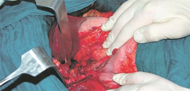 Uniklinik Essen erneut in der Kritik Lebertransplantation: Kontrolleure haben an der Uniklinik Essen Unregelmäßigkeiten moniert.