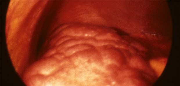 Welchen Patienten mit Leberzirrhose nutzen Betablocker? Leberzirrhose: Die Gewebevernarbungen bedingen, dass der Blutfluss umgeleitet werden muss. Da erhöht u.a. das Risiko für Ösophagusvarizen und Blutungen.