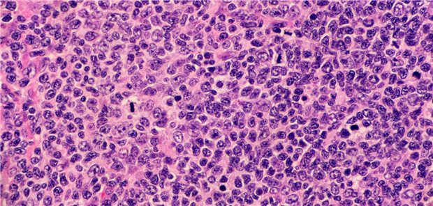 Letztlich summiert sich die Zahl der T-Zell-Lymphome mit CAR-Beteiligung in den USA auf etwa ein halbes Dutzend und eine Rate von etwa 0,01-0,02 Prozent. Auch wenn solche Komplikationen recht selten sind, wird doch über zusätzliche Sicherheitsmaßnahmen bei CAR-T-Zelltherapien diskutiert.