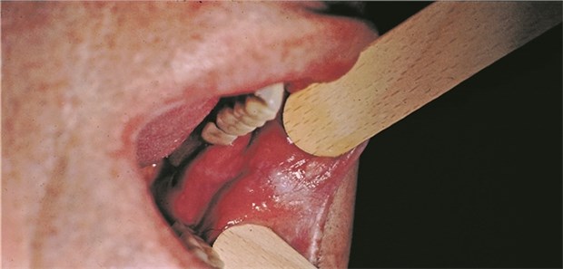 Drastisch veränderte Mundflora bei Krebs Leukoplakie: Eine histologische Abklärung bei Verdacht auf eine maligne Veränderung kann notwendig werden. Bei fast 15 Prozent der Karzinome in der Mundhöhle ist der Auslöser unbekannt.