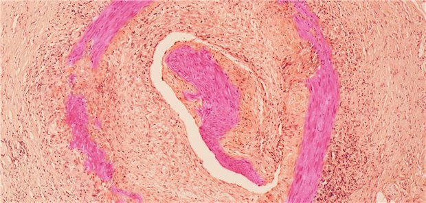 Lichtmikroskopaufnahme eines von Riesenzellarteriitis betroffenen Gefäßes.
