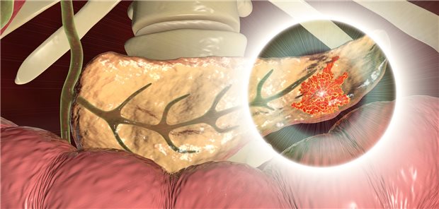 Liegt der Tumor bei Patientinnen und Patienten mit Pankreaskarzinom in unmittelbarer Nähe zu wichtigen Organen oder Blutgefäßen, ist eine vollständige operative Entfernung erschwert. (3D-Illustration)