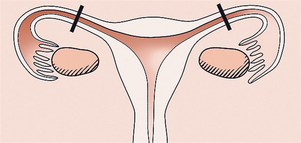 Wenig Erfolg bei älteren Frauen Liegt die operative Sterilisation schon lange zurück, ist der Erfolg einer Refertilisierung gering.