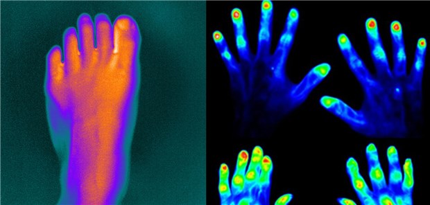 Fußkamera macht Rheumaherde sichtbar Links: Aufnahme des künstlichen Fußes, an dem Forscher die Funktionstüchtigkeit des Fußkamera-Prototypen überprüfthaben. Rechts: Aufnahmen mit einem bereits etablierten Handscanner. Sie zeigen die unterschiedliche Verteilung von Kontrastmittel in den Händen eines Gesunden (oben) und eines Rheumapatienten (unten).