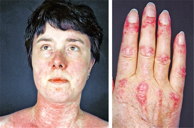 Links: Patientin mit Dermatomyositis und einem Shawl-Zeichen: Erytheme an den Wangen bis hin zur Halsregion. Rechts: Hand der Dermatomyositis-Patientin mit Gottron-Papeln über den Streckseiten der Finger.