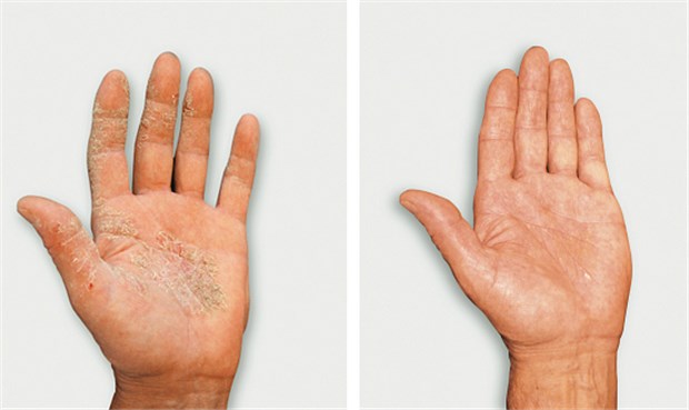 Links: schweres chronisches Handekzem. Rechts: die Hand desselben Patienten. Nach 24 Wochen Therapie mit 30 mg Alitretinoin einmal täglich ist der Hautauschlag abgeheilt.