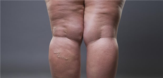 Lipödem: Grund genug für eine Fettabsaugung auf Kasse? Dazu sollen demnächst valide Studiendaten Auskunft geben.