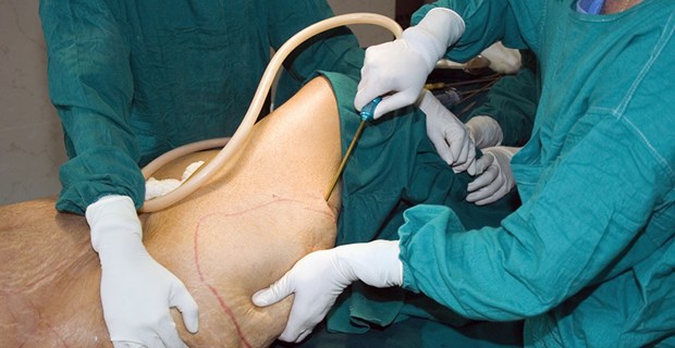 Neue Blutgefäße aus abgesaugtem Fett Liposuktion: Das gewonnen Material soll jetzt für die Gewebezüchtung verwendet werden.