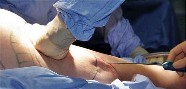 Liposuktion: In der vertragsärztlichen Versorgung müssen die Krankenkassen bisher nur für Patienten im Stadium III die Behandlung bezahlen.