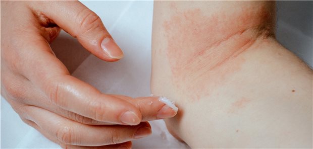 Lokale Therapie bei atopischem Ekzem.