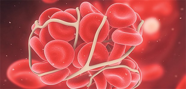 Zwei Faktoren sagen Thrombose-Rezidive vorher Lokalisation und Typ des Erstereignisses zeigen bei Älteren das VTE-Rezidivrisiko an.