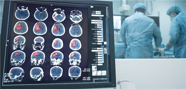 Lokalisierter Herd: Entscheidend ist es, die Zeit vom Auftreten des Schlaganfalls bis zum Beginn der Lyse zu verkürzen.